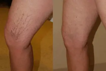 Veinaritin