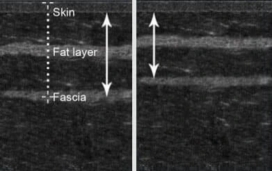 différences d'épaisseur de graisse corporelle