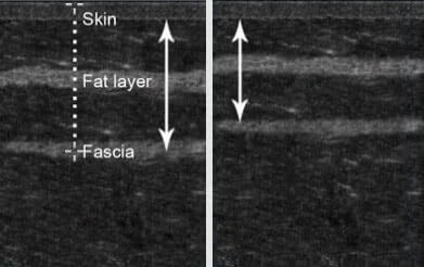 Obrázok ukazuje rozdiel v hrúbke tukového tkaniva v prípade osoby vyšetrenej pred použitím BeSlimmer a po 2 týždňoch používania.